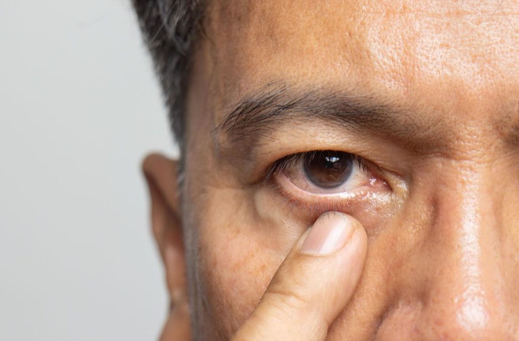 A close-up of an older adult's eye that is showing signs of early cataract formation.