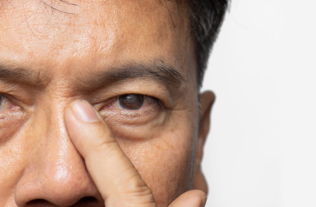 An older adult rests a finger on the bridge of his nose. His eyes have cataracts.