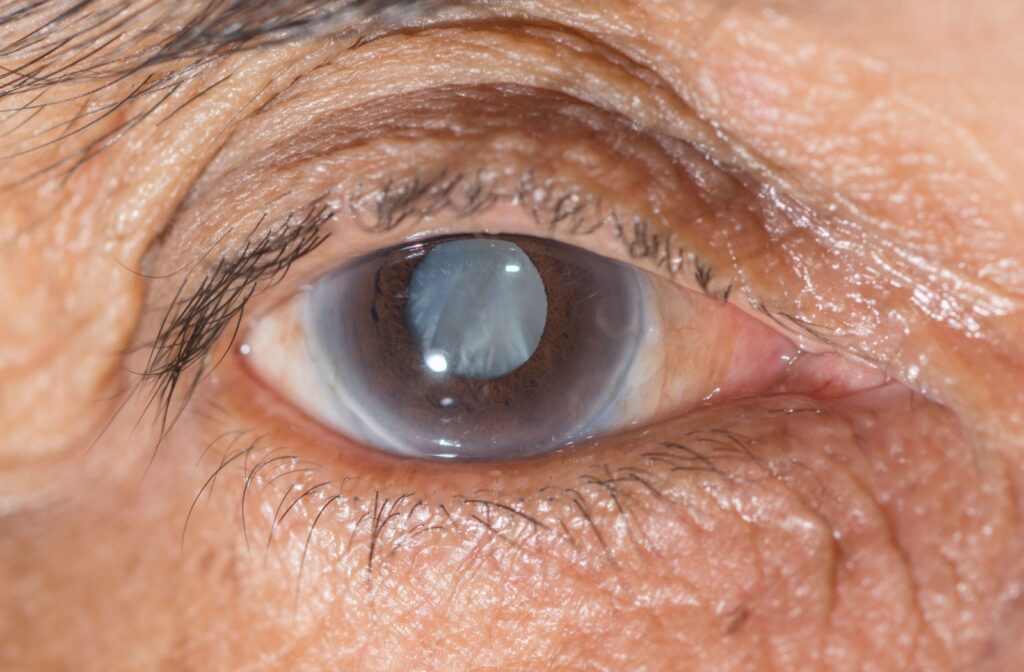 Close-up image of an older adult's eye showing a cloudy, opaque lens, indicative of a mature cataract. The cornea appears clear, while the pupil is obscured by the grayish-white cataract, suggesting impaired vision.