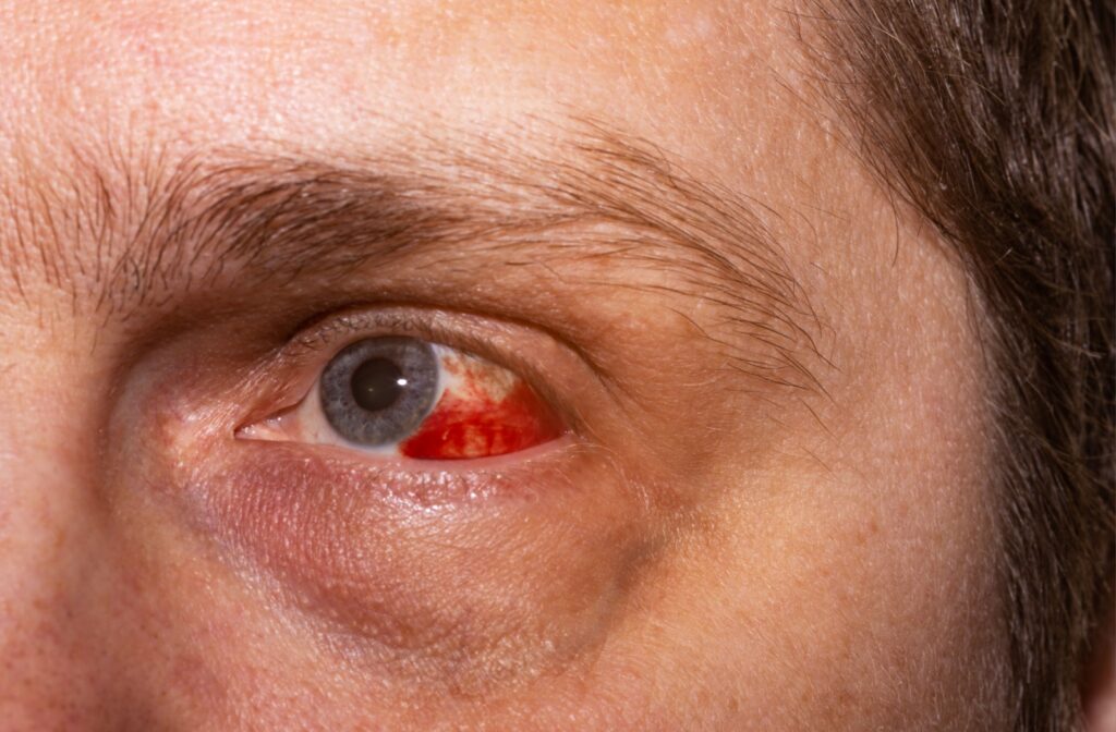 Close up image of man's hurt and bloodshot left eye.